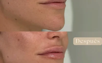 Labios con armonía: cómo realzar tu sonrisa con ácido hialurónico de forma segura y natural
